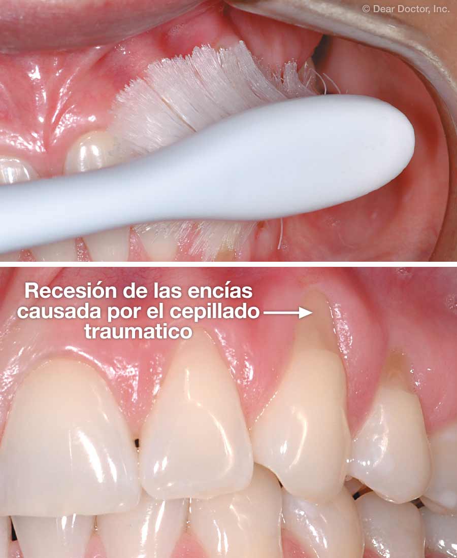Recesión de las encías causada por el cepillado traumatico.